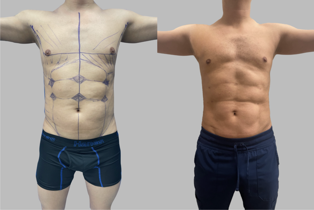 before and after pictures of a high-definition liposuction patient.