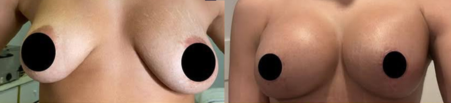 Before and 3 months After an L-Scar Multiplane Mastopexy (Breast Lift) and Augmentation by Dr. Tolomeo